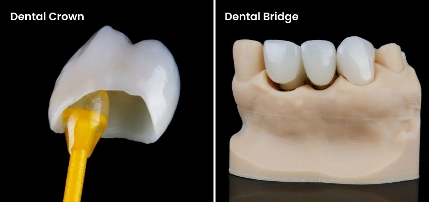 Dental Crowns and Bridges