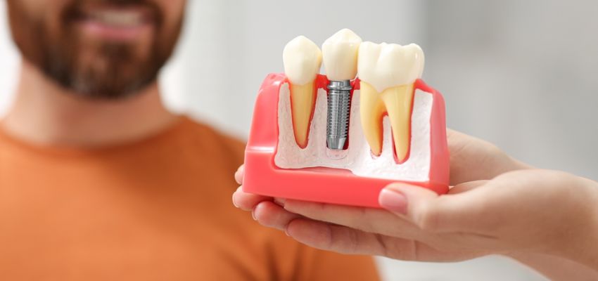 Dental Implants