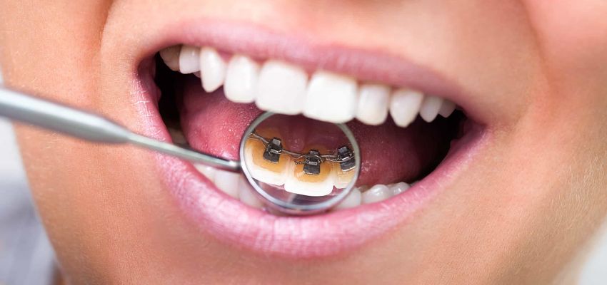 Lingual-Braces-Treatment