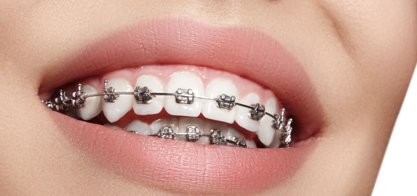 Orthodontic Treatment