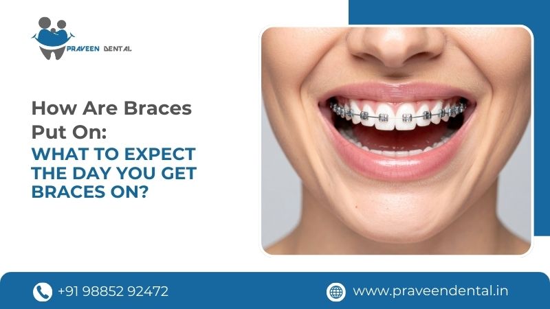 How Are Braces Put On: What to Expect the Day You Get Braces On?
